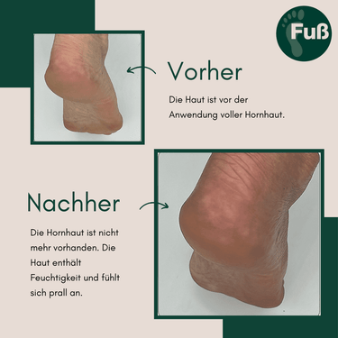Fuß-Spezial Pflegeschaum gegen Hornhaut & Schrunden 150ml